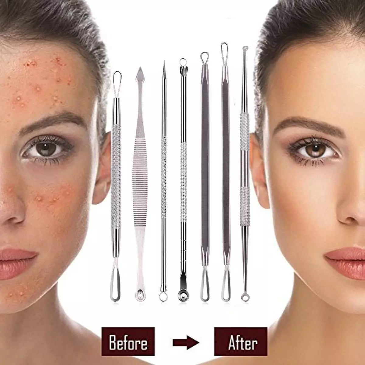 Monwell™ Precision Blackhead Remover Toolkit – Luxury Stainless Steel Pore Extractor Set